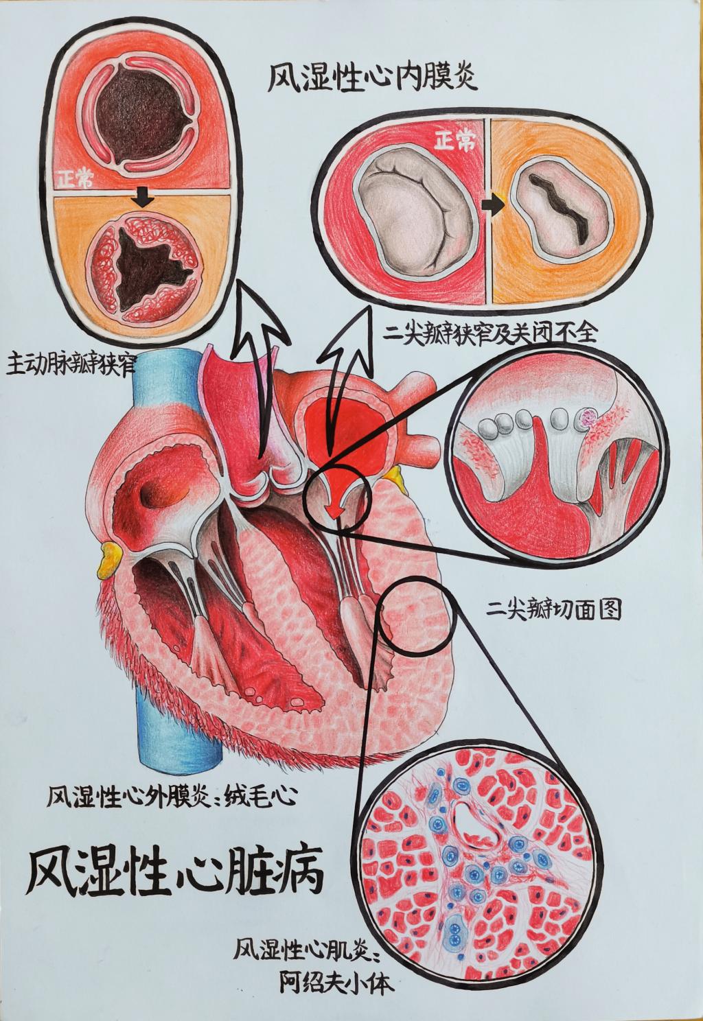 2. 邮寄手绘 作品分类 2 风湿性心脏病 青岛大学 张晨彤