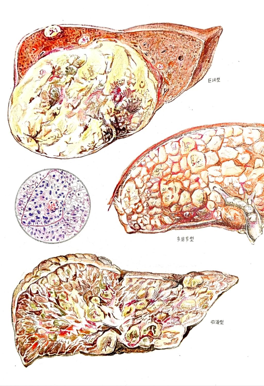 5. 邮寄手绘 作品分类 2 肝细胞癌的病理变化 青岛大学 韩培航